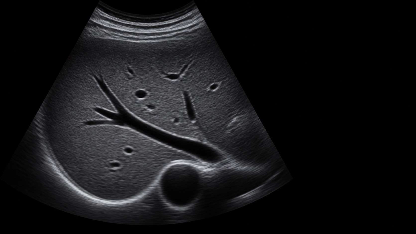 Conceptual B-mode liver ultrasound visualization showing tissue and vascular detail