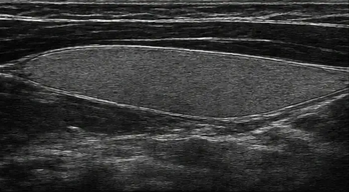 Thyroid ultrasound view with illustrative processing