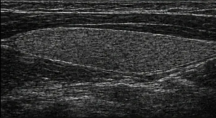 Thyroid ultrasound view before illustrative processing